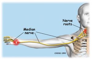 Carpal Tunnel Syndrome